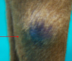 Filariosi cutanea (Dirofilaria repens)