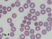 Nelle anemie immunomediate si possono evidenziare gli sferociti.
