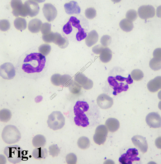 Leucocitosi neutrofila da flogosi acuta: si osservano neutrofili maturi e un neutrofilo non segmentato