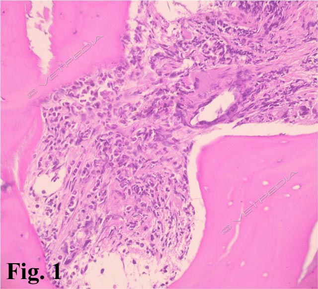 La mielofibrosi si caratterizza per la progressiva sostituzione del tessuto ematopoietico ad opera di tessuto connettivo