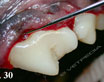 Il IV° premolare superiore è spesso oggetto di patologie che ne comportano l’estrazione