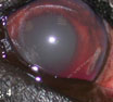 Linfoma oculare in cui si osservano segni aspecifici di uveite
