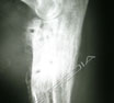 Osteosarcoma insorto in un distretto osseo nel quale erano stati inseriti impianti metallici 