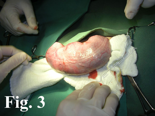 . Taglio cesareo: esteriorizzazione dell’utero gravido attraverso la celiotomia.