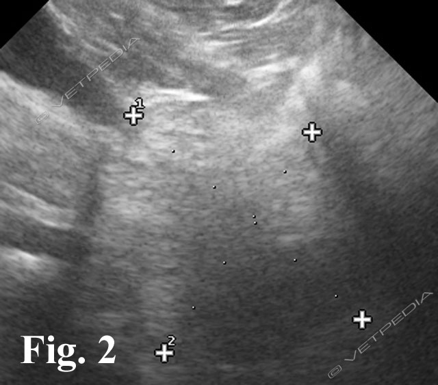 Iperplasia prostatica: prostata aumentata di volume, con parenchima complessivamente iperecogeno e finemente disomogeneo 