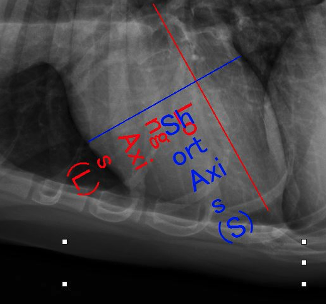 Degenerazione mixomatosa della mitrale