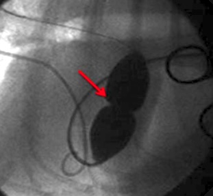 Stenosi polmonare nel cane
