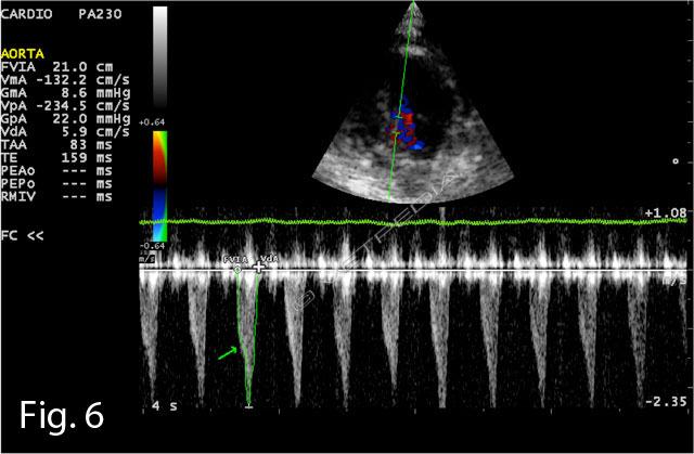 insufficienza cardiaca congestizia secondaria a  miocardiopatia ipertrofica in un gatto