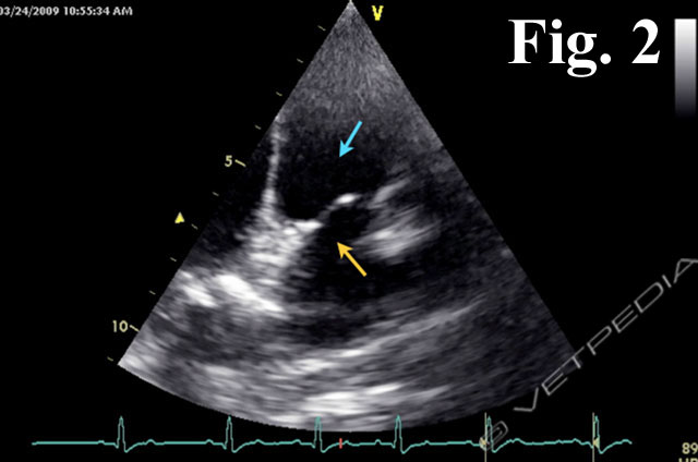 Dotto arterioso pervio (PDA)