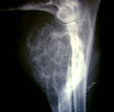 Tumore a cellule giganti (osteoclastoma) del cane