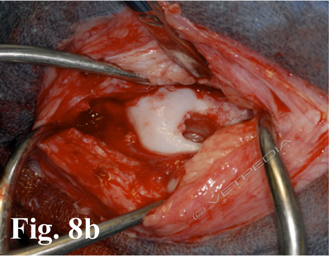 Osteocondrite dissecante (OCD) del ginocchio