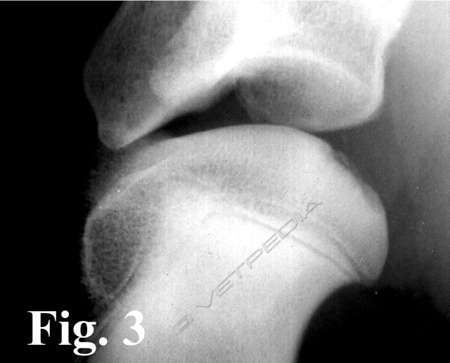 Osteocondrite dissecante (OCD) della testa omerale 