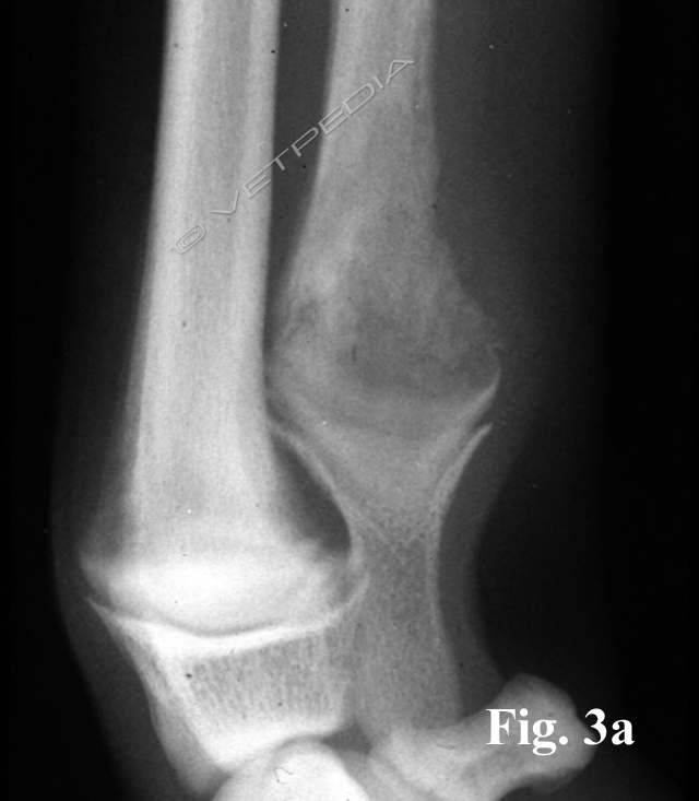 Osteomielite ematogena acuta