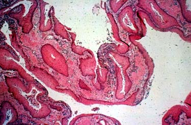 Metaplasia squamosa della prostata nel cane